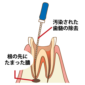 インプラント