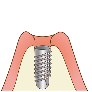 インプラント